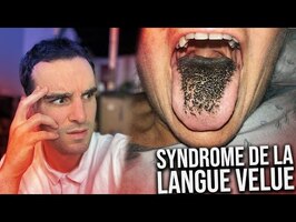 Les plus étranges syndromes (syndrome de la langue velue)